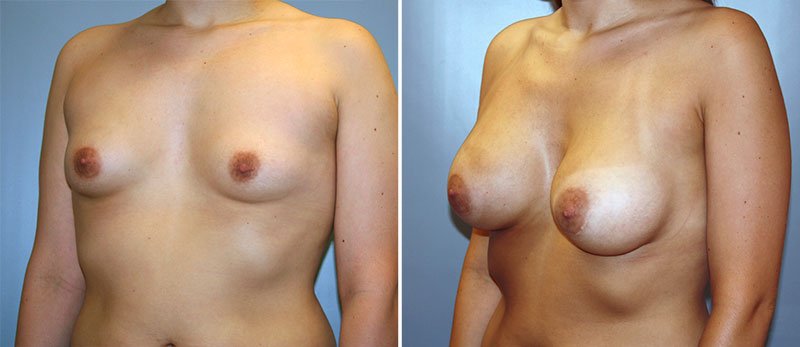 breast enlargement philadelphia celebrities thumbs sex