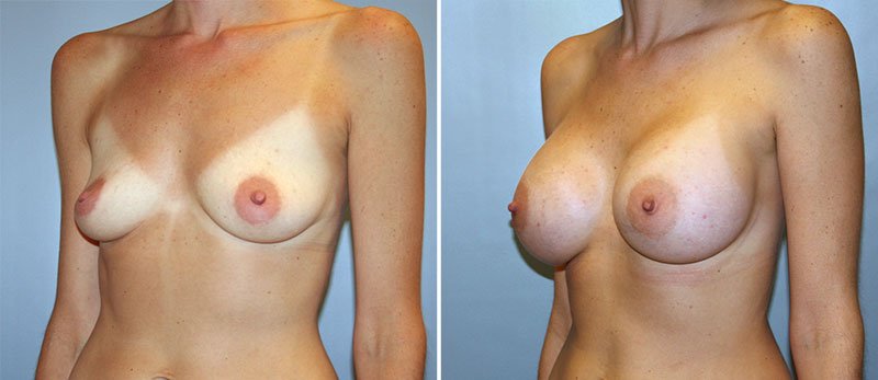 Specializing in quick recovery breast augmentation, cosmetic surgery, and breast  implants. and exploring the options available for enhancing your natural  beauty through plastic surgery.. To put this video on your site, use the URL  below or.
