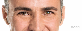 Eyelid Lift Model Eyelid Lift Model