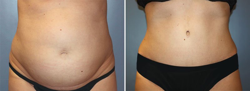 Tummy Tuck Patient 1