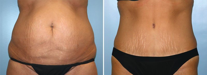 Tummy Tuck Patient 2