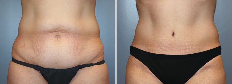 Tummy Tuck Patient 4