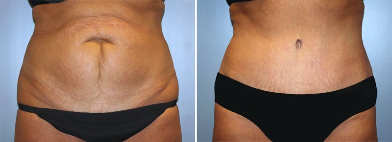 Tummy Tuck Patient 6