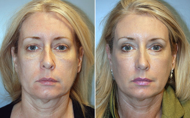 Fraxel Laser Skin Resurfacing Patient 1