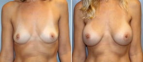 Breast Augmentation Patient 8