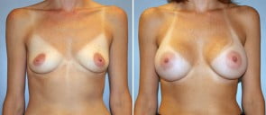 Breast Augmentation Patient 1