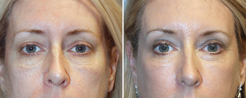 Eyelid Rejuvenation Patient 1