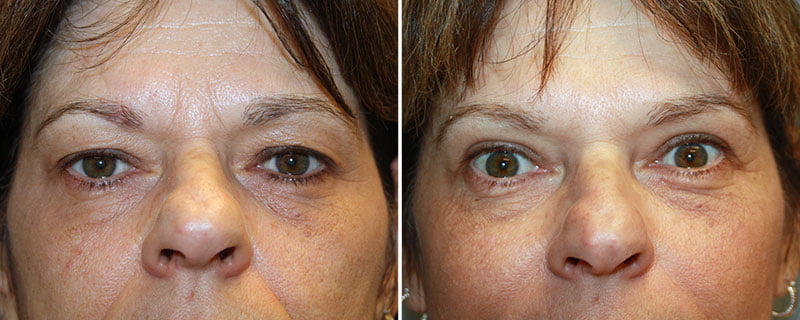 Eyelid Rejuvenation Patient 2