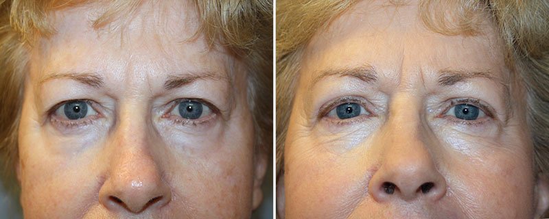 Eyelid Rejuvenation Patient 3