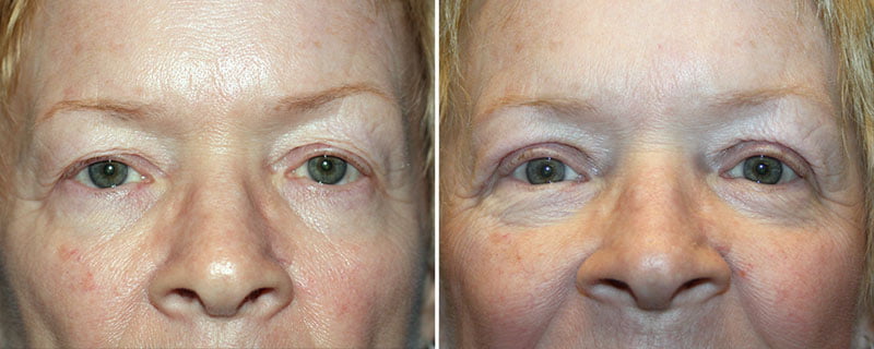 Eyelid Rejuvenation Patient 5