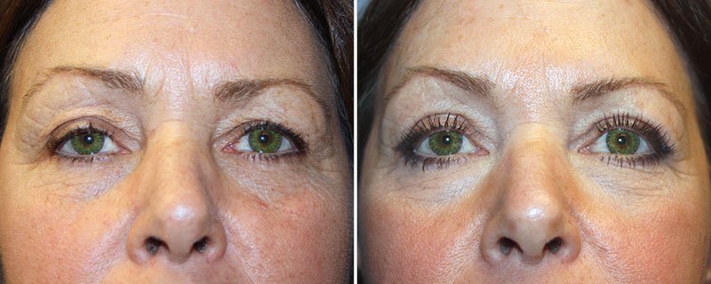 Eyelid Rejuvenation Patient 7