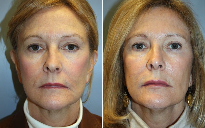 Fraxel Laser Skin Resurfacing Patient 5