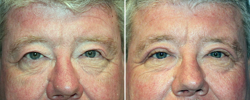 Eyelid Rejuvenation Patient 6