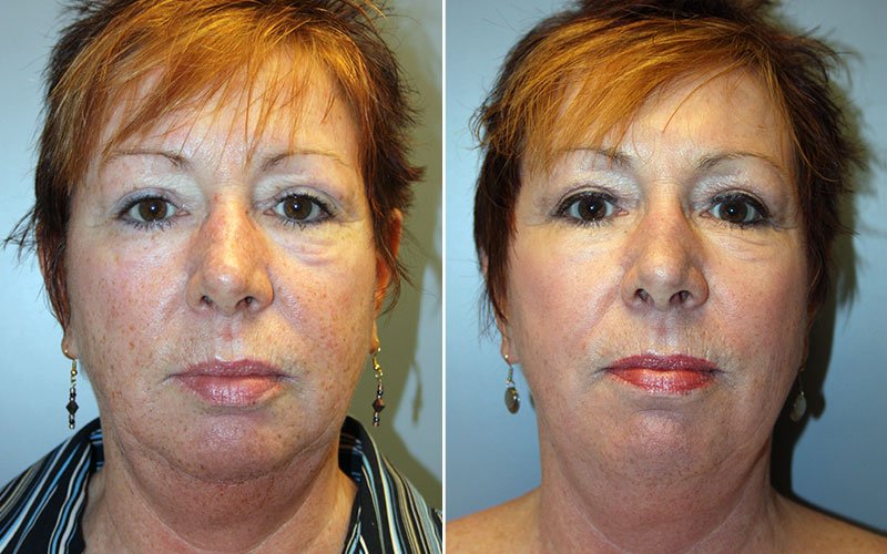 Fraxel Laser Skin Resurfacing Patient 2