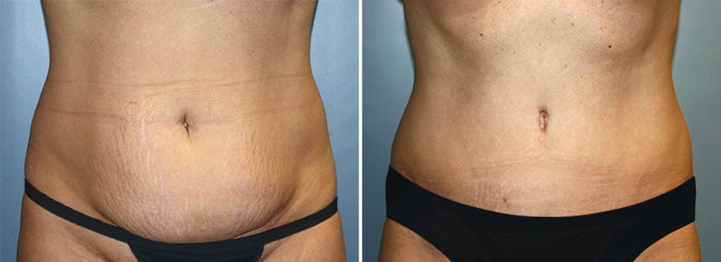 Tummy Tuck Patient 22