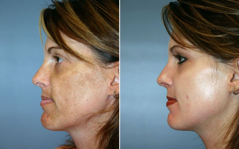 OBAGI Blue Peel Patient 1 - Berks Plastic Surgery