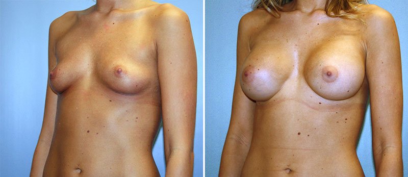 You pennsylvania breast implant augmentation share Pennsylvania breast implant augmentation