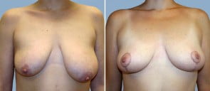 Breast Lift Patient 1