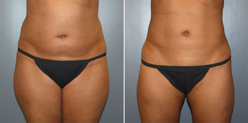 Liposuction Patient 3