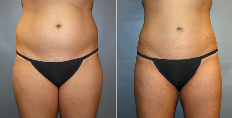 Liposuction Patient 4