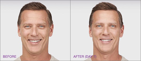 male botox before and after