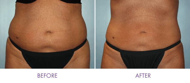 CoolSculpting Before and After