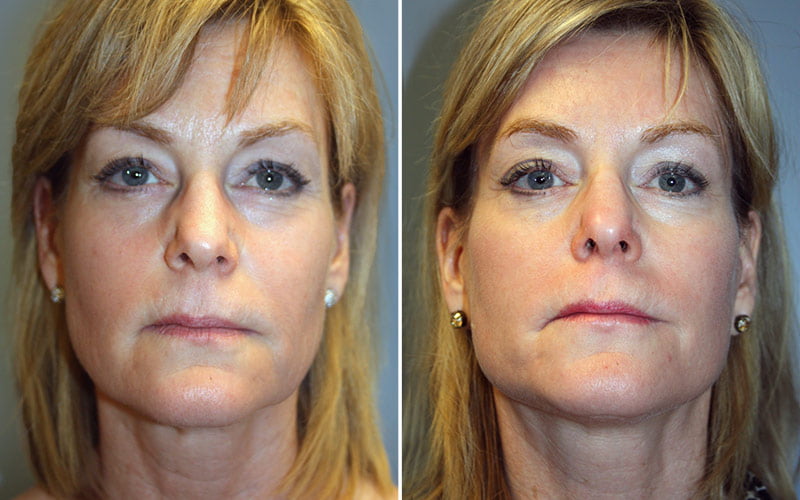 Facelift with Fraxel Laser Patient 1