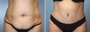 harrisburg-pa-tummy-tuck-with-liposuction-a