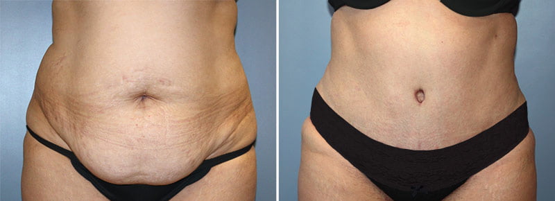 Tummy Tuck Patient 10