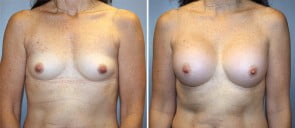 Breast Augmentation Patient 18