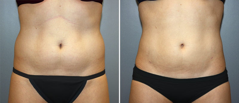 Liposuction Patient 5