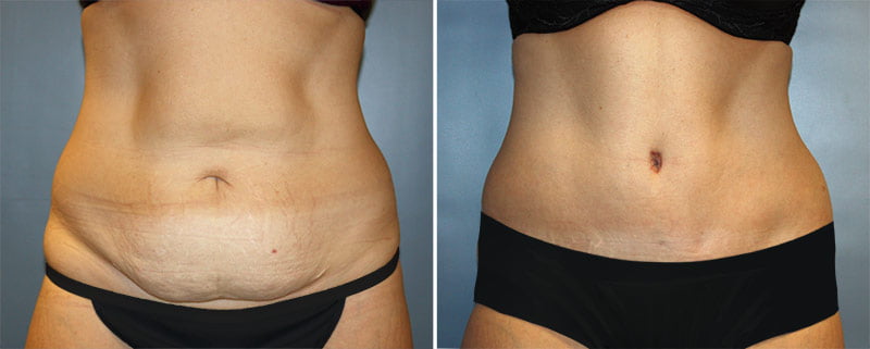 Tummy Tuck Patient 9