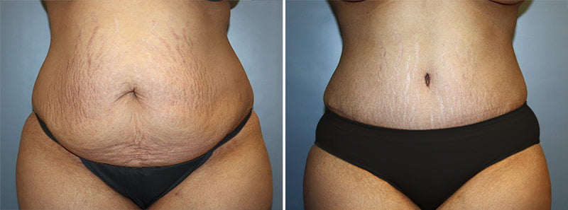 Tummy Tuck Patient 11