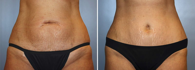 Tummy Tuck Patient 12