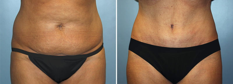 Tummy Tuck Patient 8