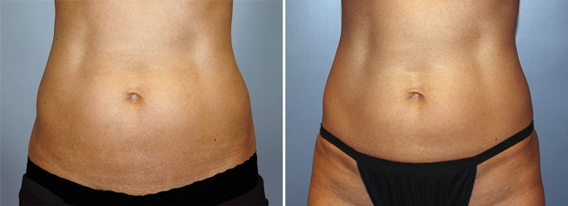 CoolSculpting® Patient 7