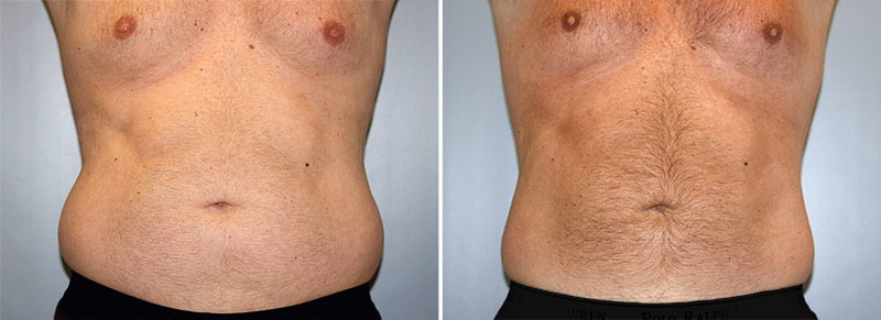 CoolSculpting® Patient 1