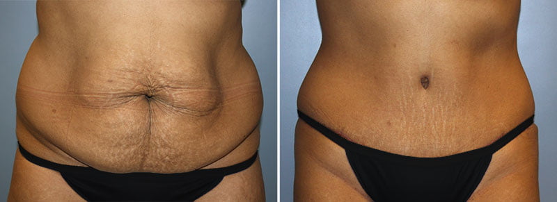 Tummy Tuck Patient 13