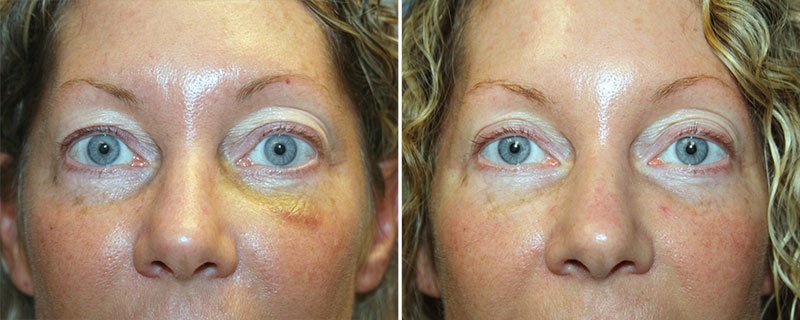 Eyelid Rejuvenation Patient 8