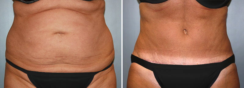 Tummy Tuck Patient 14