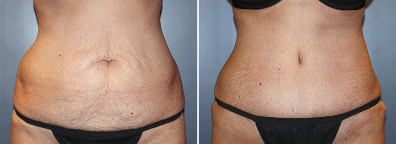 Tummy Tuck Patient 16