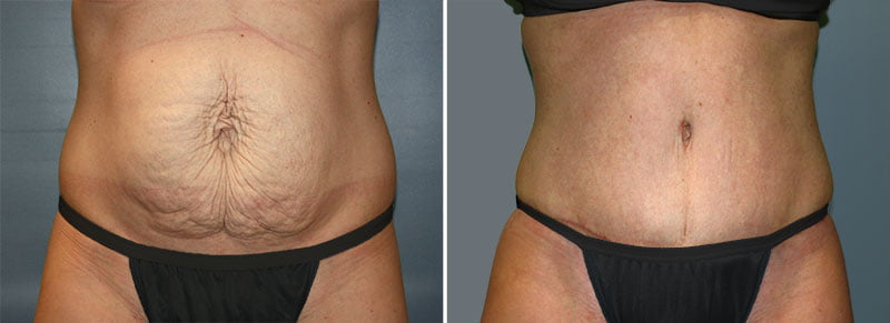 Tummy Tuck Patient 17