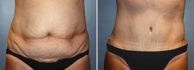 Tummy Tuck Patient 15