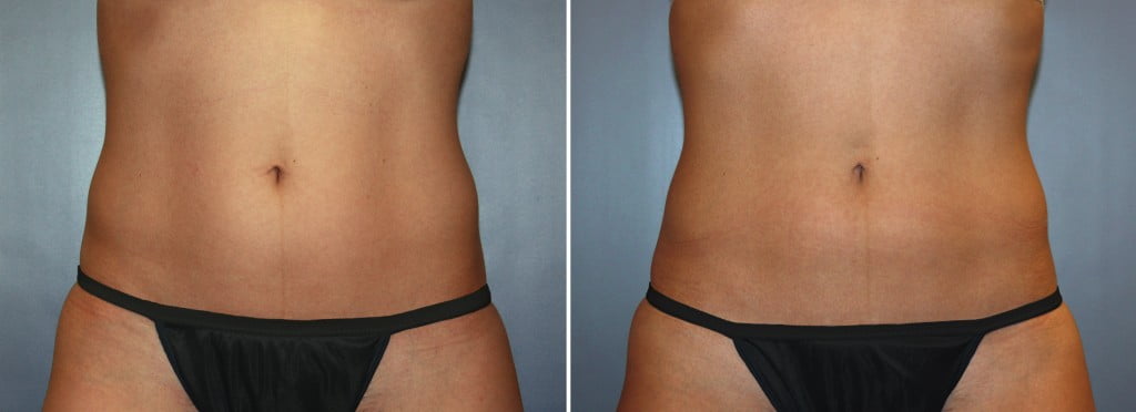 CoolSculpting® Patient 8