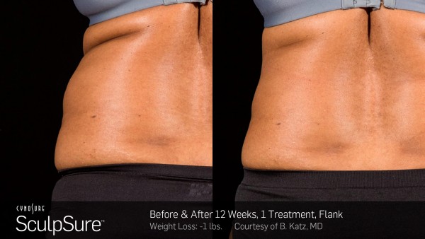 Dr Jennifer Walden | Non-Invasive Fat Reduction | Austin, TX