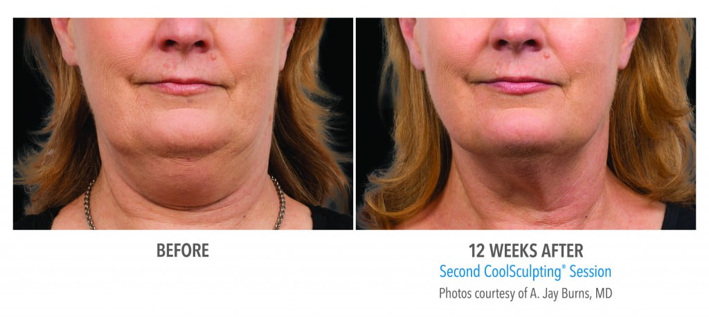 before and after Coolsculpting session