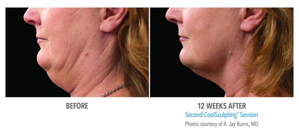 before and after second CoolSculpting Session before and after second CoolSculpting Session