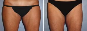 abdominoplasty-7785a-2-liposuction-outer-thighs