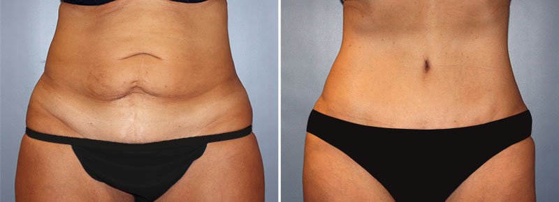 Tummy Tuck Patient 19