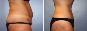 abdominoplasty-7785c-liposuction-outer-thighs